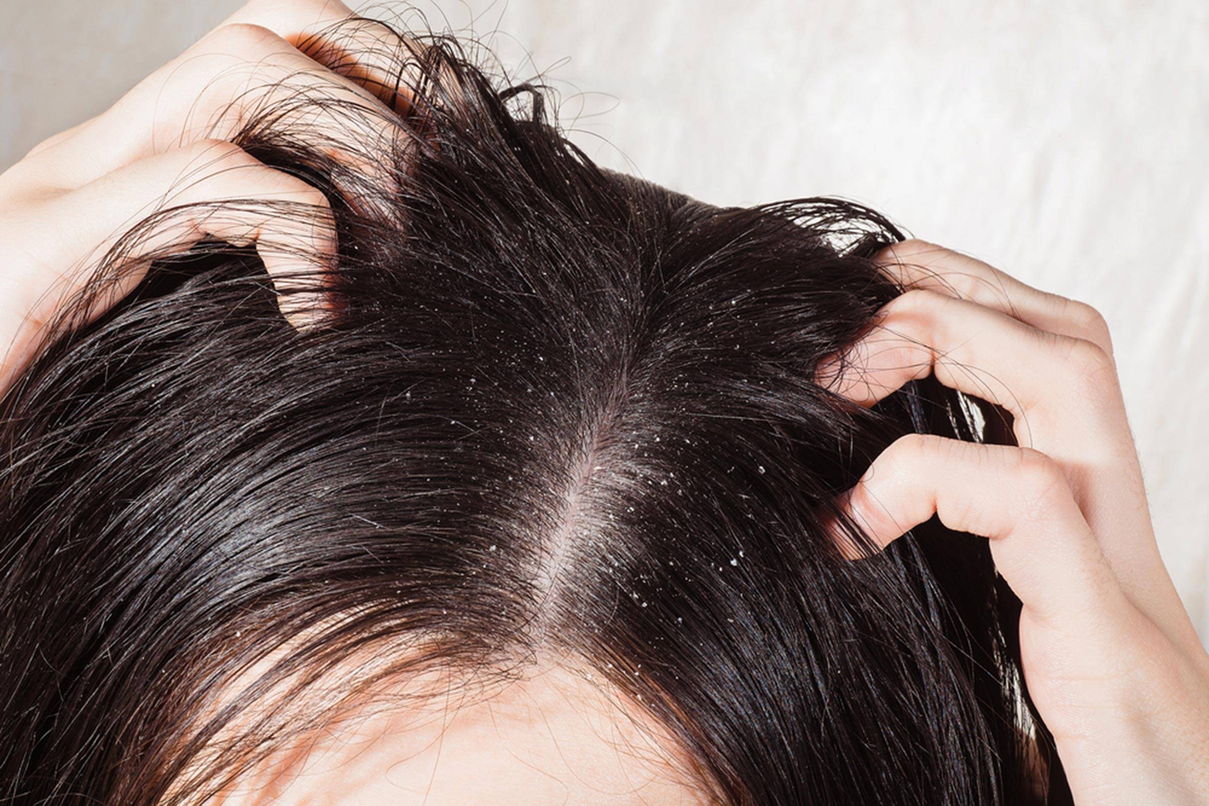 2400px x 1600px - Make your hair dandruff free in easy manner - LetsDiskuss
